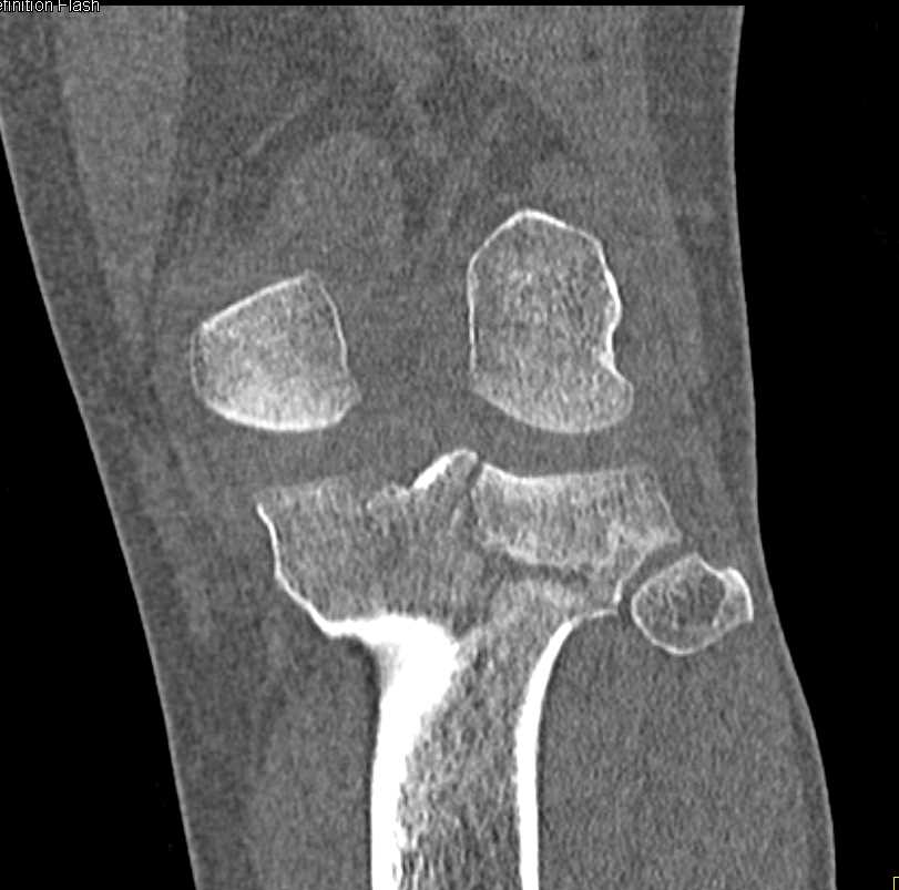 Tibial Plateau Fracture - CTisus CT Scan