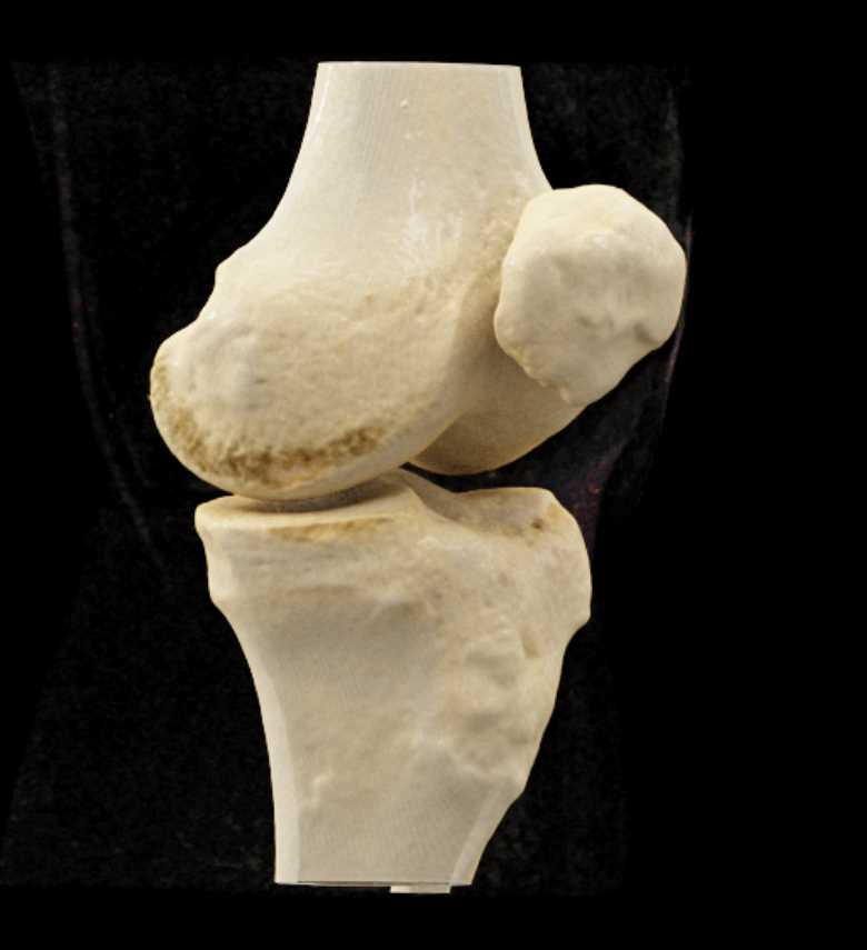 Tibial Plateau Fracture - CTisus CT Scan