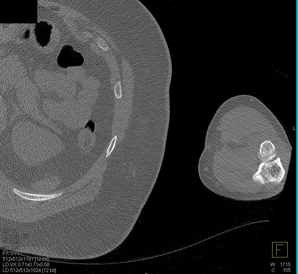 Impacted Humerus Fracture - CTisus CT Scan