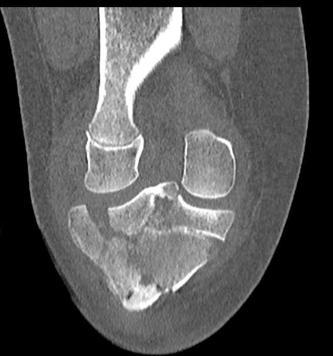 Tibial Plateau Fractures - CTisus CT Scan