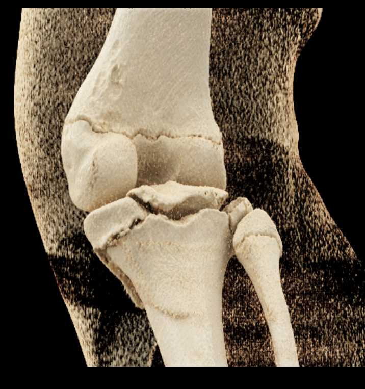 Tibial Plateau Fractures with Cinematic Rendering - CTisus CT Scan