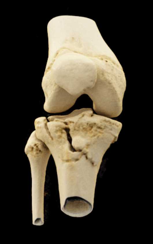 Tibial Plateau Fracture - CTisus CT Scan