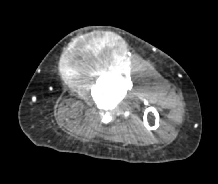 Soft Tissue Sarcoma with Tibial Destruction - CTisus CT Scan