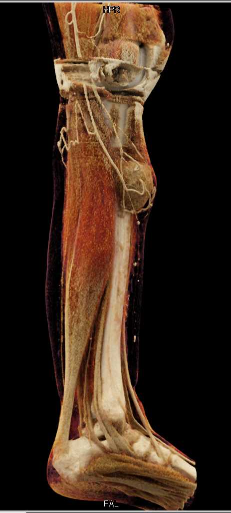 Soft Tissue Sarcoma with Tibial Destruction - CTisus CT Scan