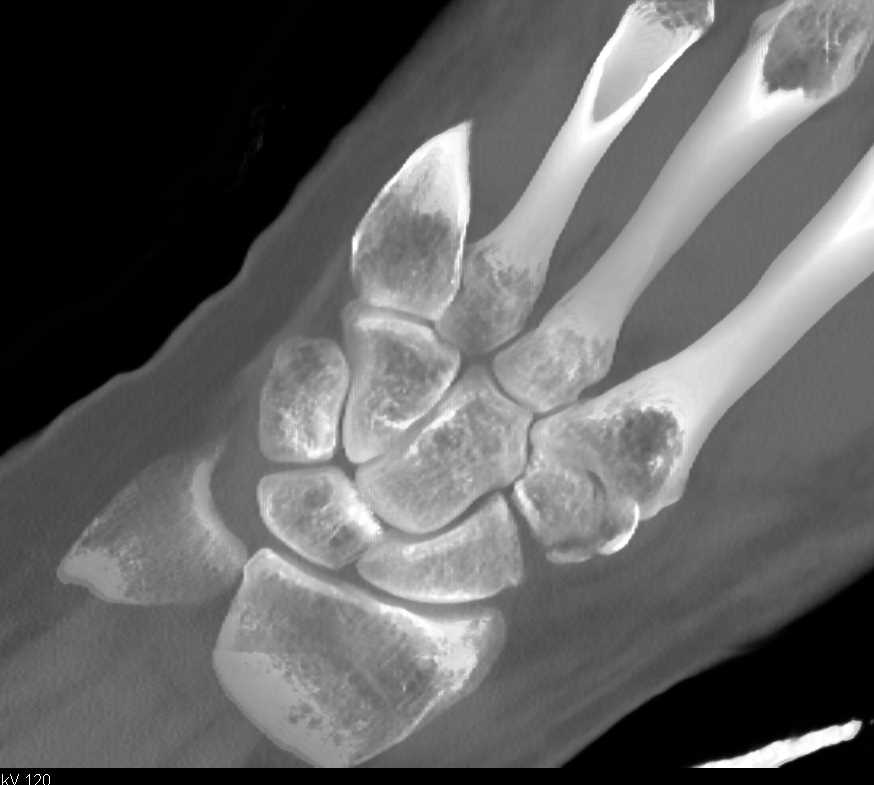 Multiple Carpal and Metacarpal Fractures - CTisus CT Scan