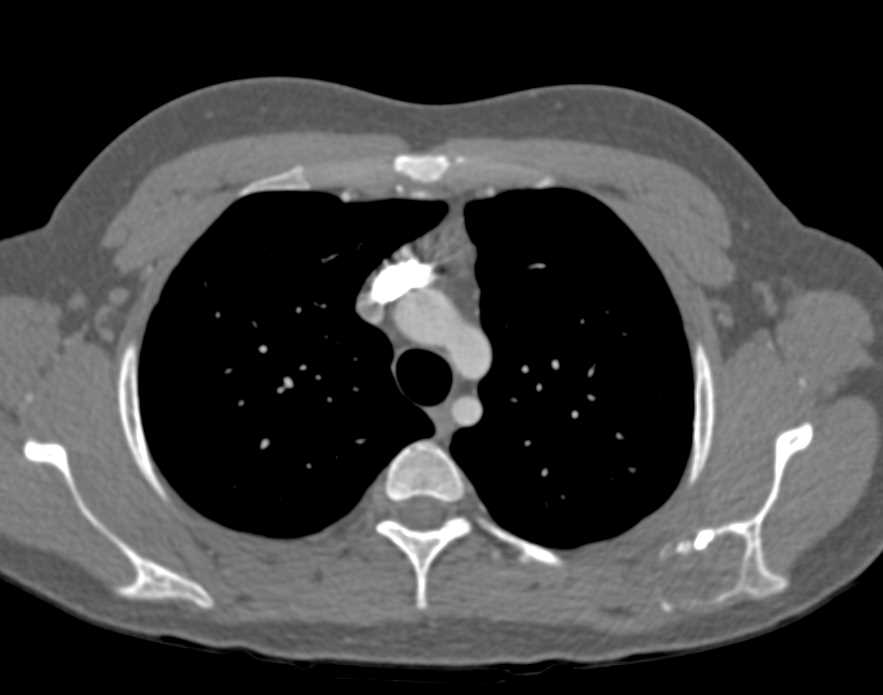 Metastatic Lesion Left Scapula - CTisus CT Scan