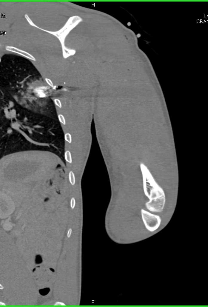 Gunshot Wound (GSW) Humerus with Fracture but no Vascular Injury - CTisus CT Scan