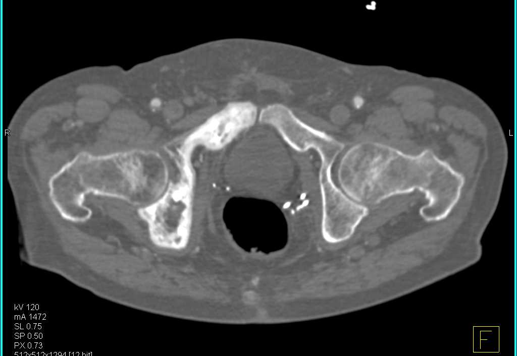 Paget's Disease - CTisus CT Scan