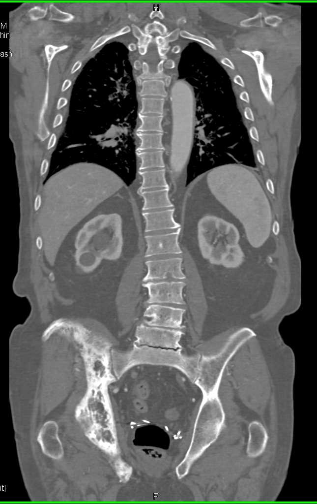 Pagets Disease - CTisus CT Scan