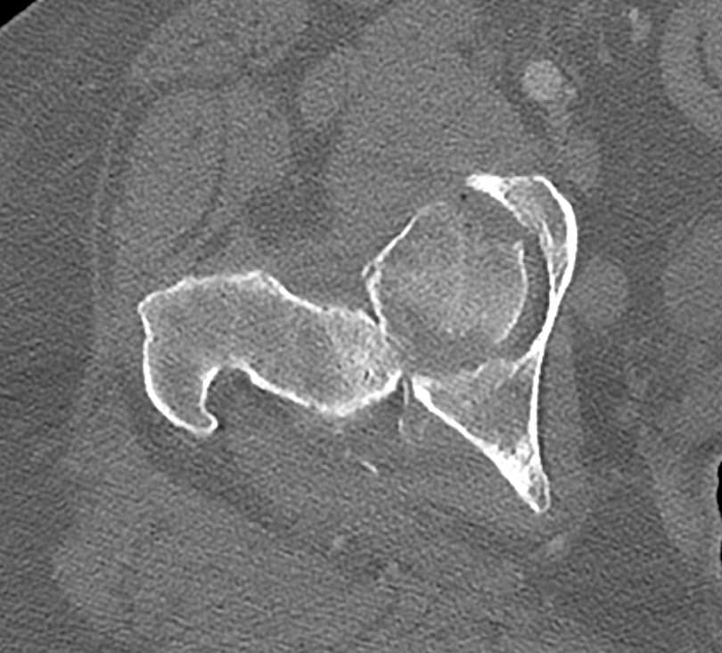 Femur Fracture and Dislocation - CTisus CT Scan