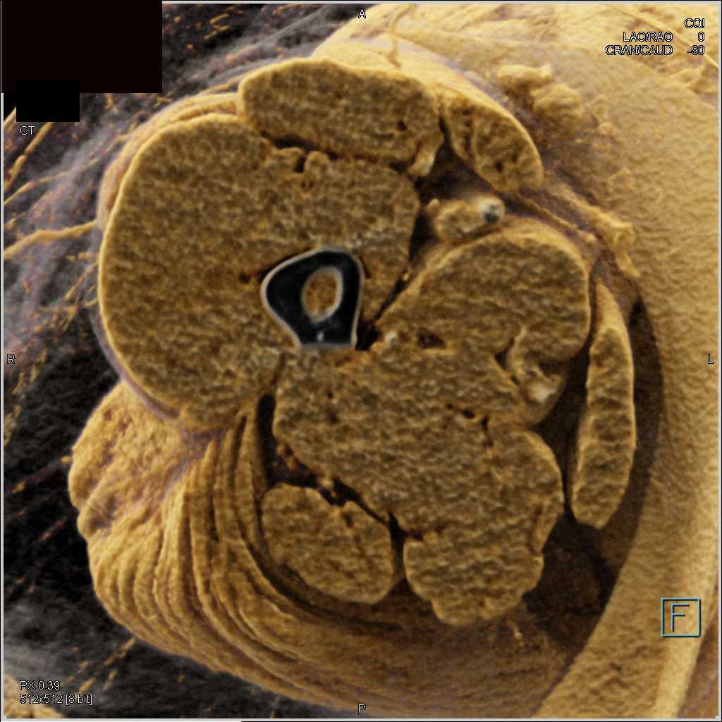 Femur Fracture and Dislocation with Cinematic Rendering - CTisus CT Scan