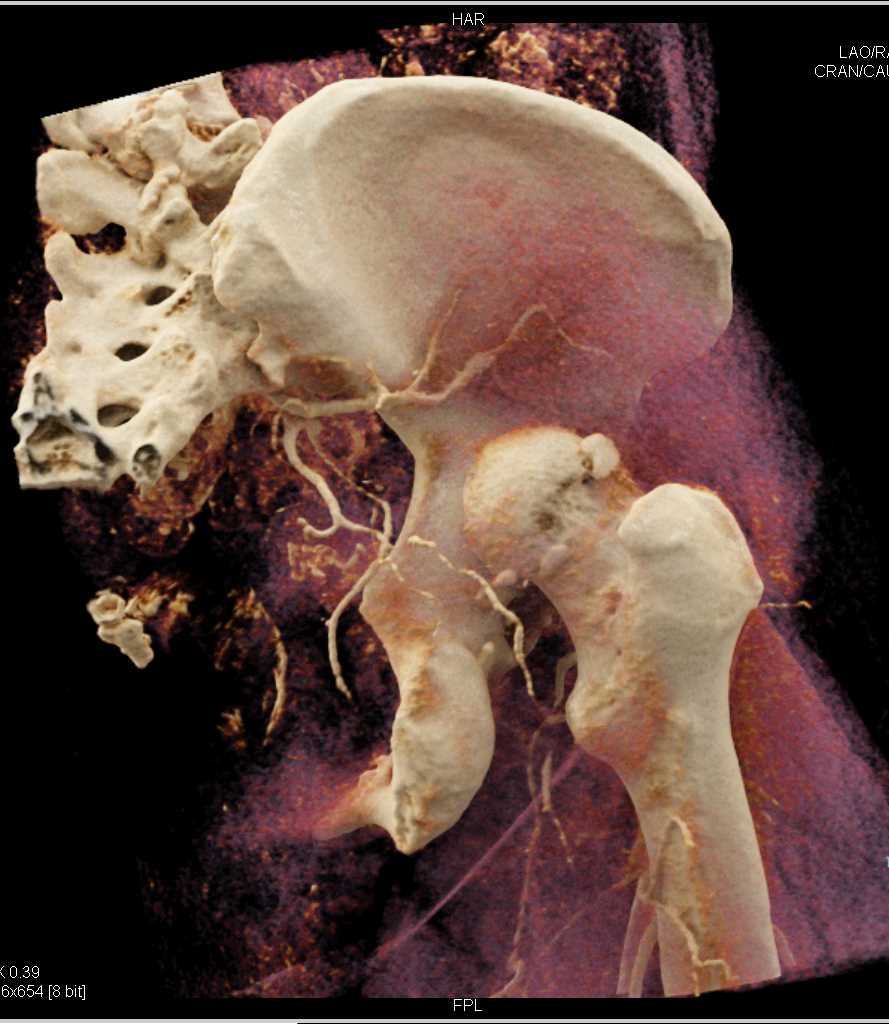 Femur Fracture and Dislocation with Cinematic Rendering - CTisus CT Scan