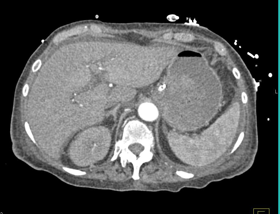 Infected Disc Space L1-L2 - CTisus CT Scan