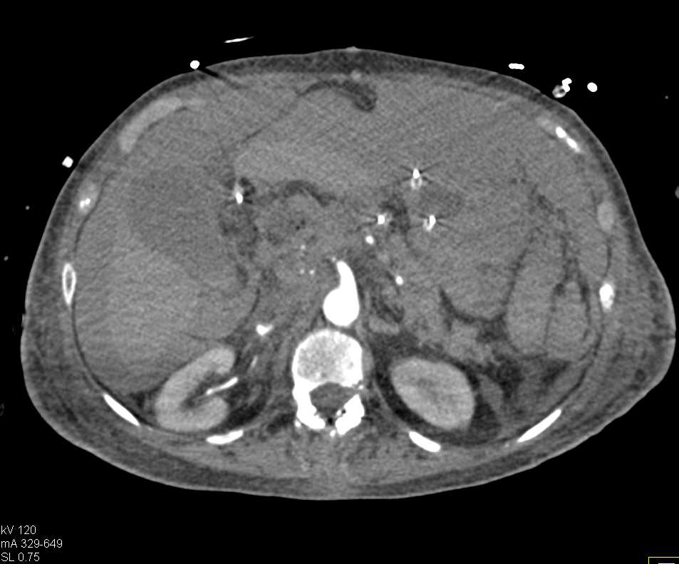 Infected Disc Space L1-L2 - CTisus CT Scan