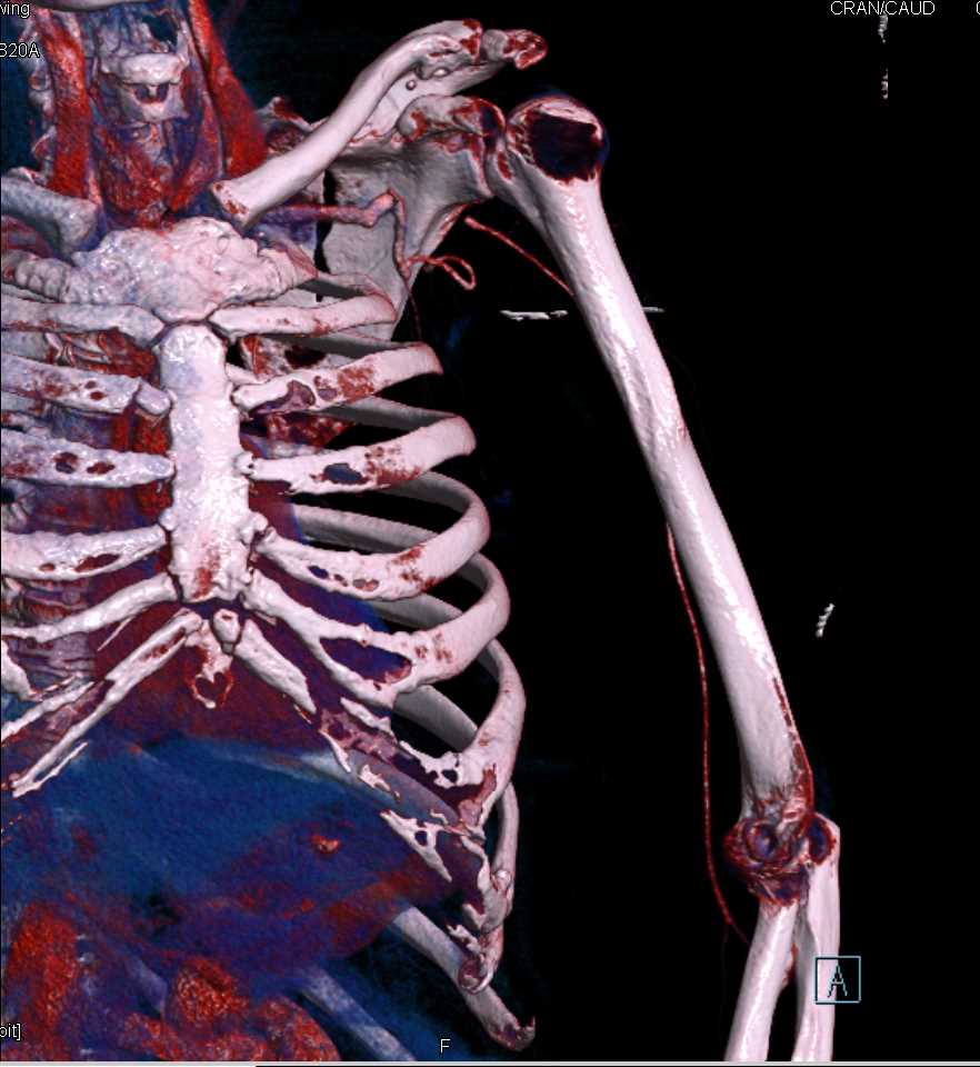 Scapular Fracture with Cinematic Rendering - CTisus CT Scan