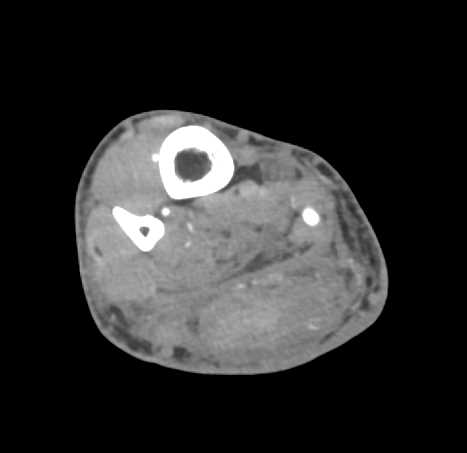 Hematoma Calf - CTisus CT Scan