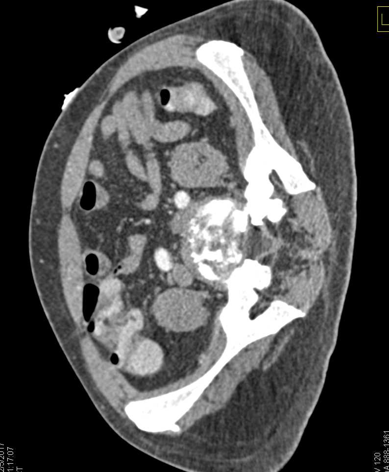 Infected Disc Space at L5-S1 with Osteomyelitis - CTisus CT Scan