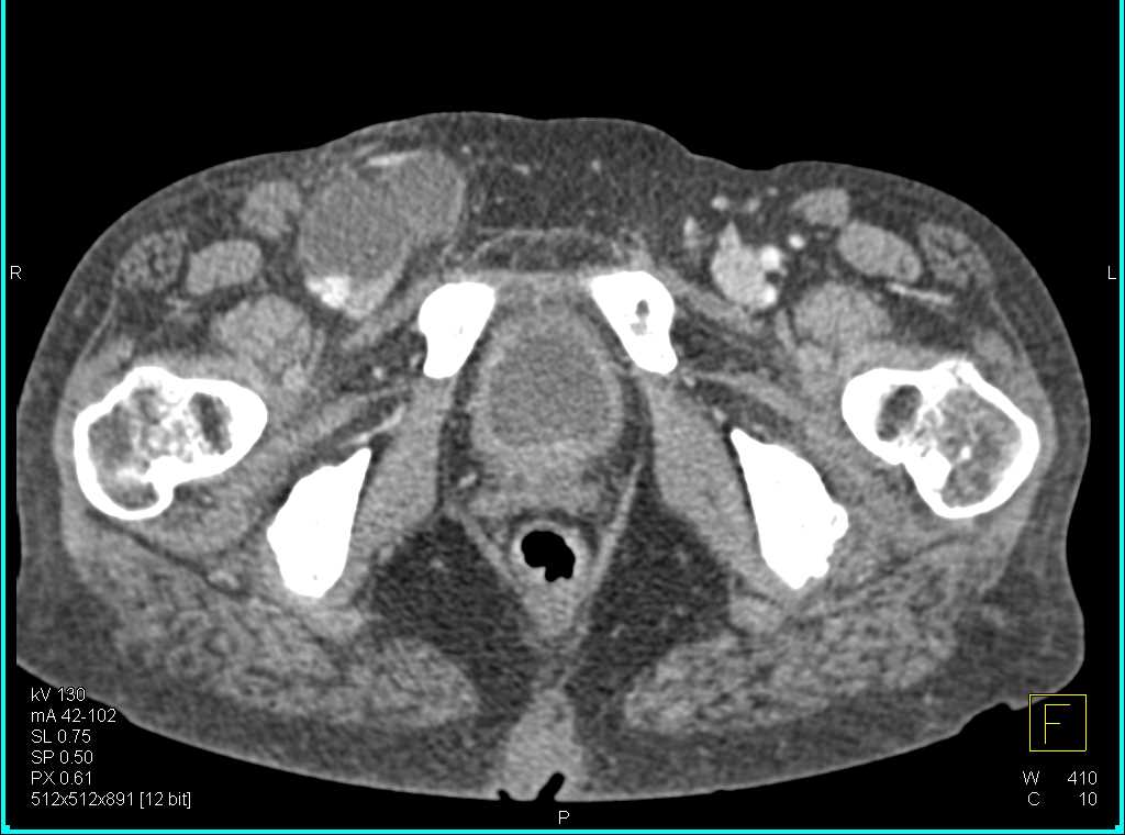 Widespread Blastic Bone Metastases - CTisus CT Scan