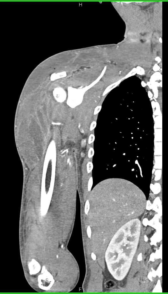 Intramuscular Abscess Upper Arm - CTisus CT Scan