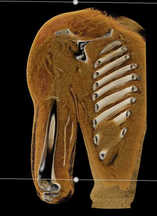 Intramuscular Abscess Upper Arm - CTisus CT Scan