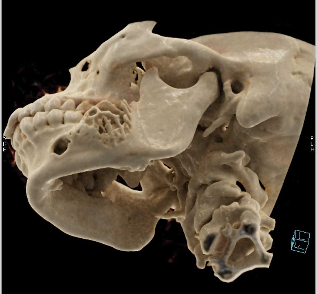 Ameloblastoma of the Mandible with Cinematic Rendering - CTisus CT Scan