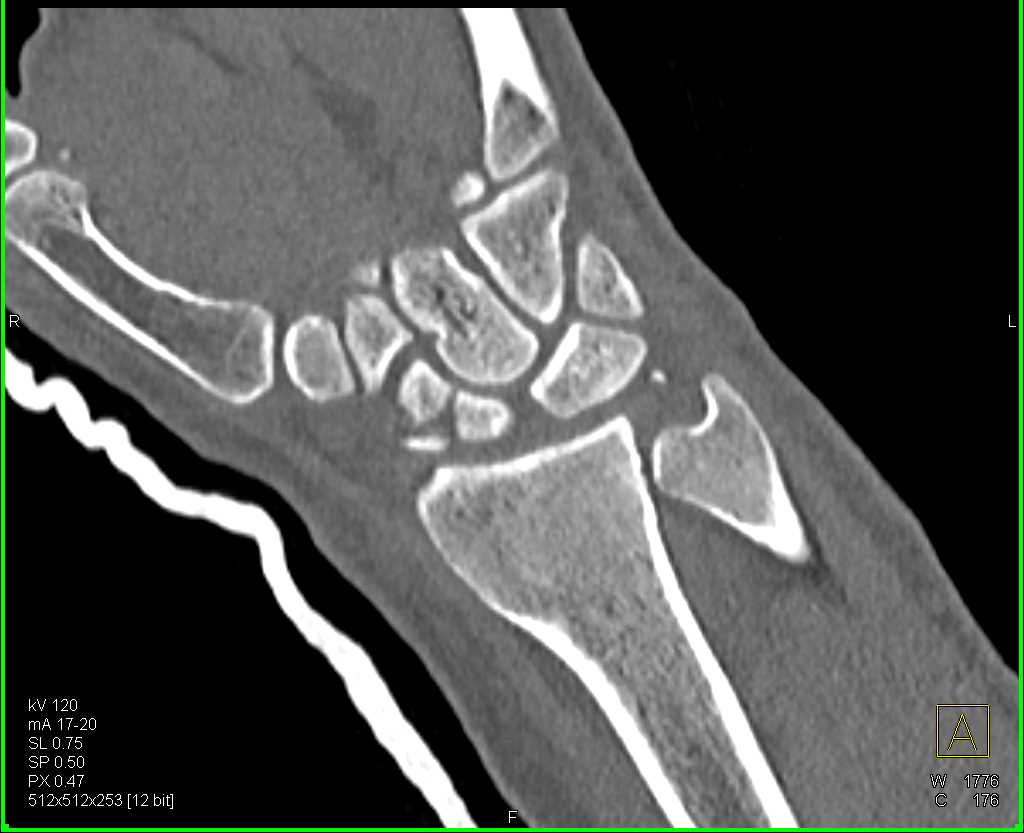 Fracture/Dislocation of the Carpal Bones - CTisus CT Scan