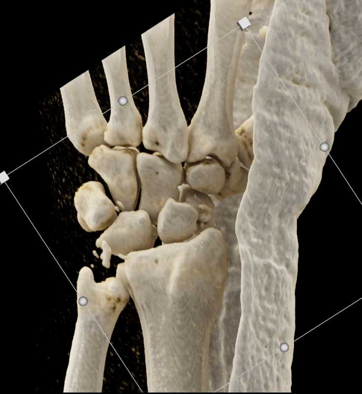 Fracture/Dislocation of the Carpal Bones with Cinematic Rendering - CTisus CT Scan