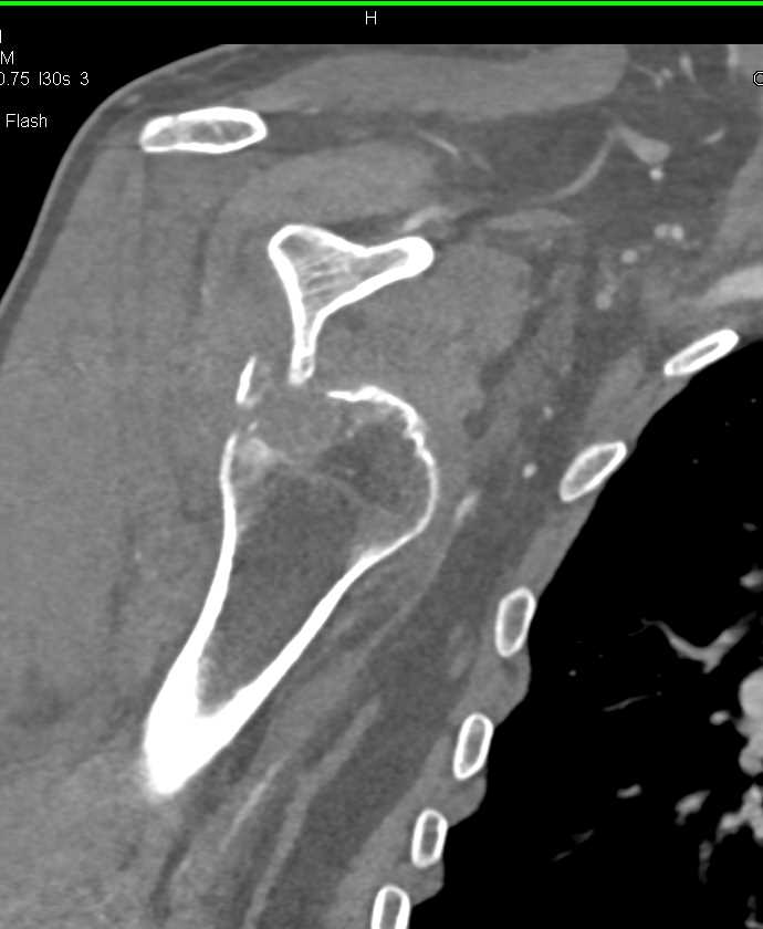 Fracture with Dislocation of the Right Humerus - CTisus CT Scan