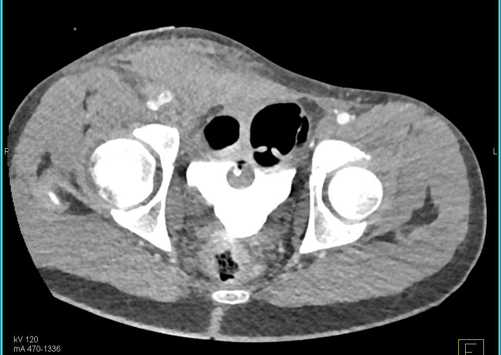 Hematoma Right Groin with Active Bleed - CTisus CT Scan