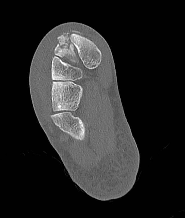 Midfoot Fractures - CTisus CT Scan