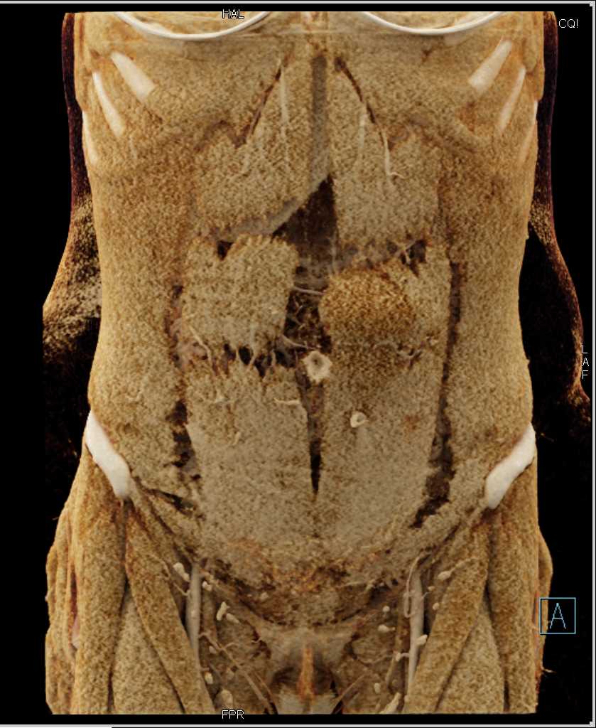 Left Rectus Hematoma - CTisus CT Scan