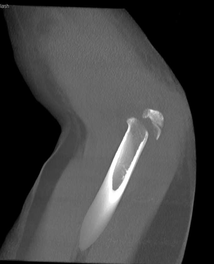 Distal Humerus Fracture in Cast - CTisus CT Scan