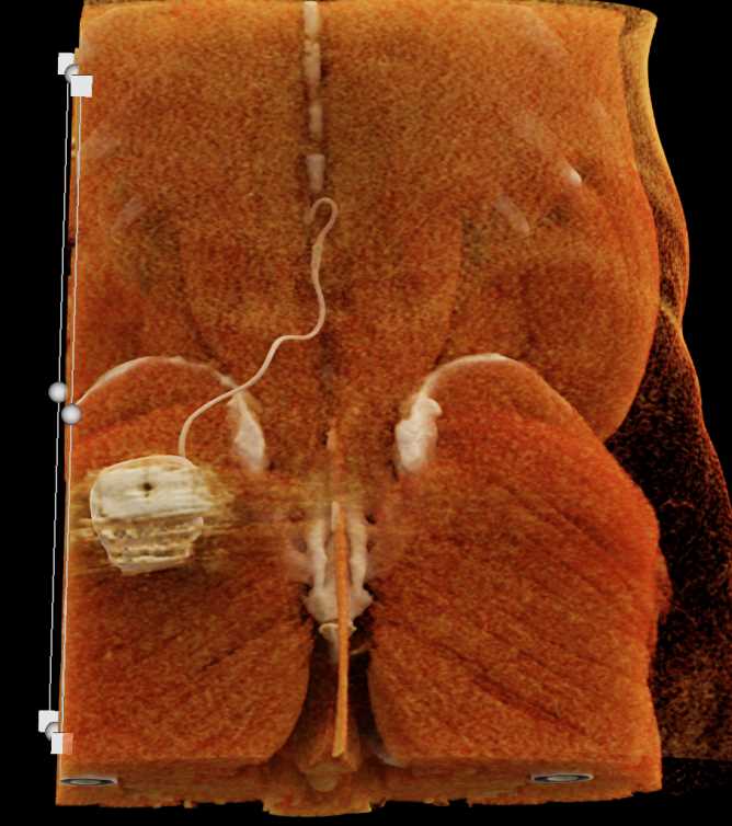 Spinal Stimulator - CTisus CT Scan