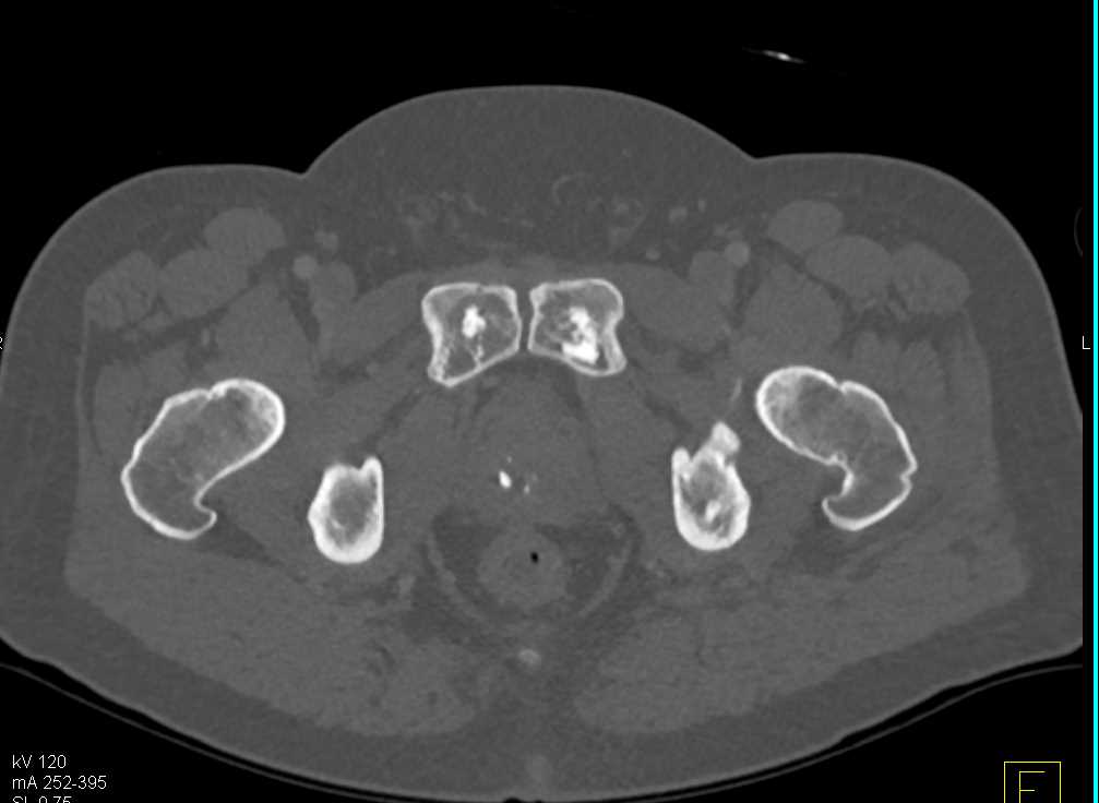 Blastic Bone Metastases - CTisus CT Scan