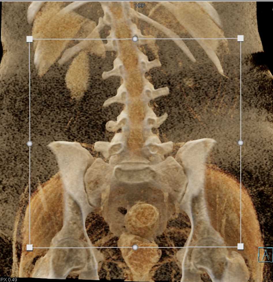 Spinal Cord with Cinematic Rendering - CTisus CT Scan