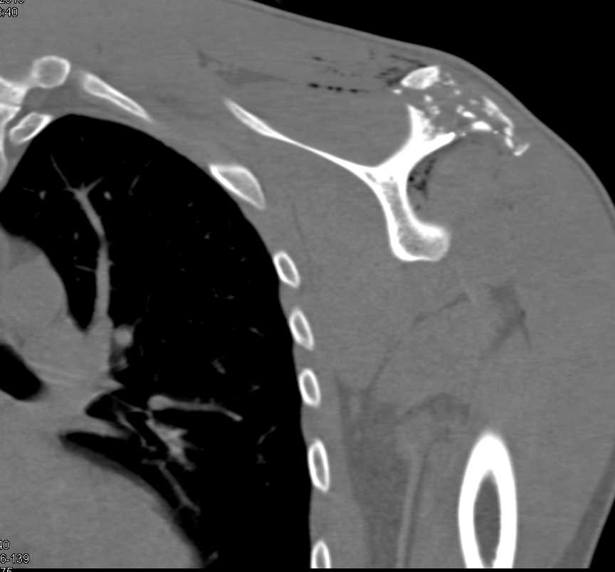 GSW with Scapular Fracture - CTisus CT Scan