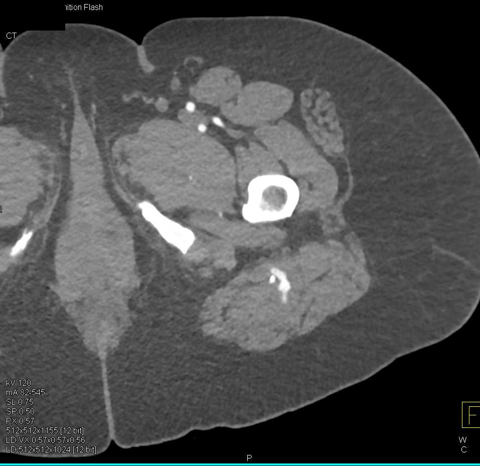 Trauma with Foreign Body in the Buttocks with Bleed - CTisus CT Scan