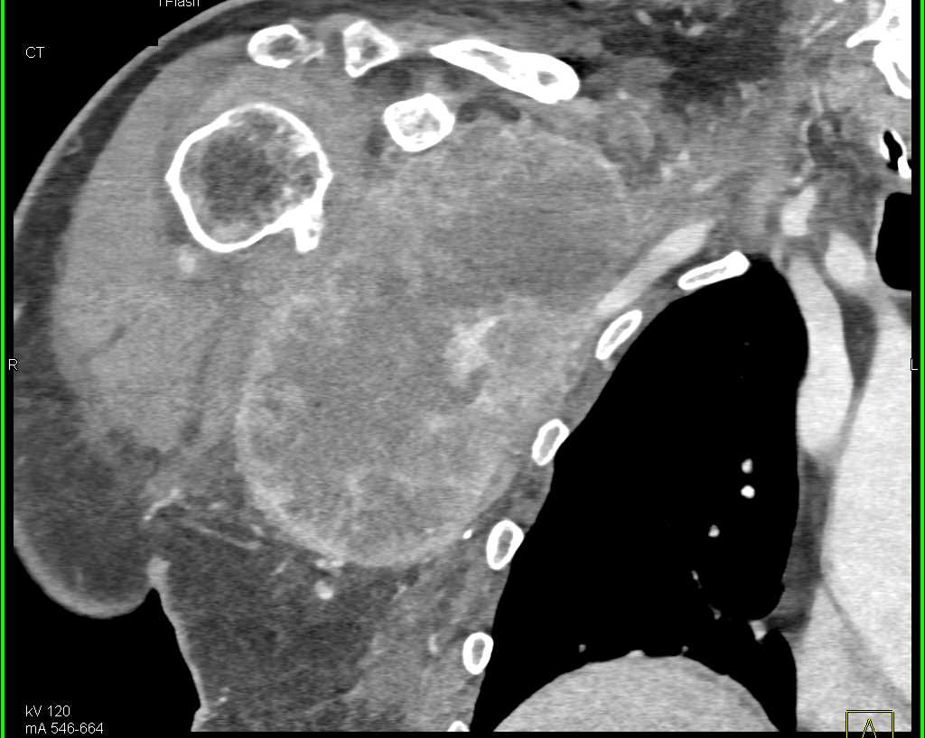 Sarcoma Right Axillary Region - CTisus CT Scan