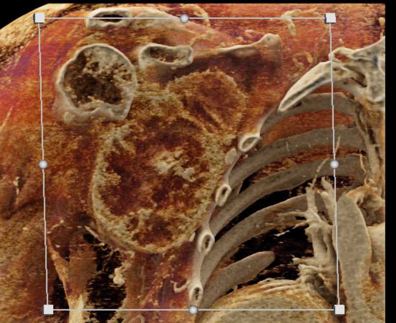 Sarcoma Right Axillary Region - CTisus CT Scan