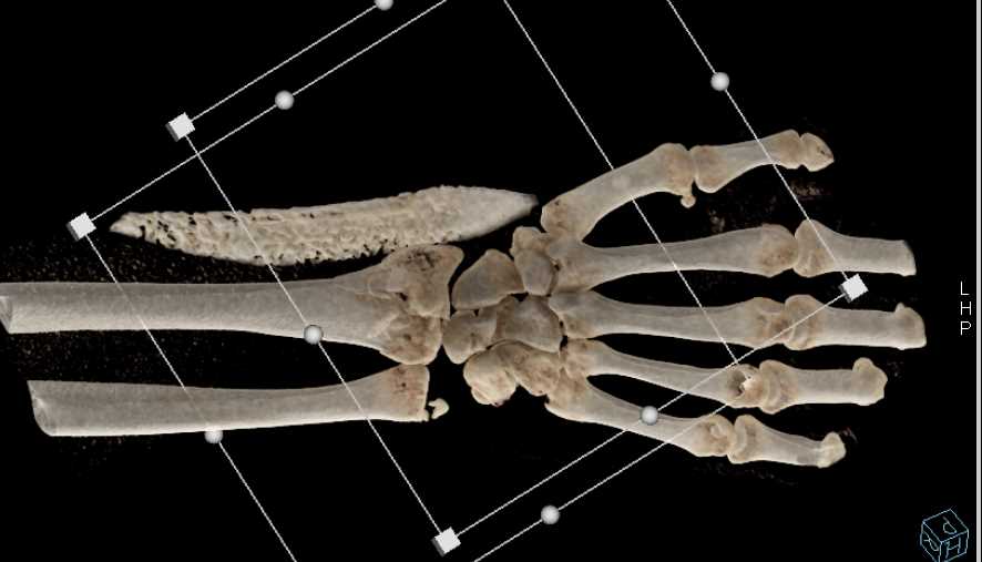 Distal Radius and Ulnar Fracture - CTisus CT Scan