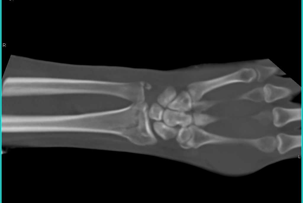 Distal Radius and Ulnar Fracture - CTisus CT Scan