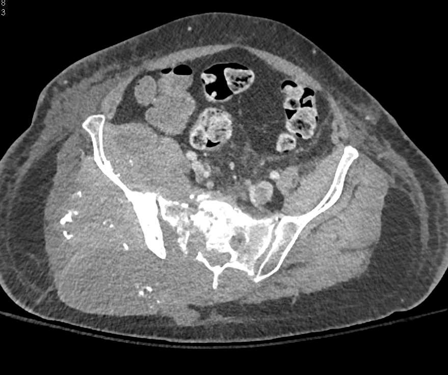 Chondrosarcoma Right Iliac Wing - CTisus CT Scan