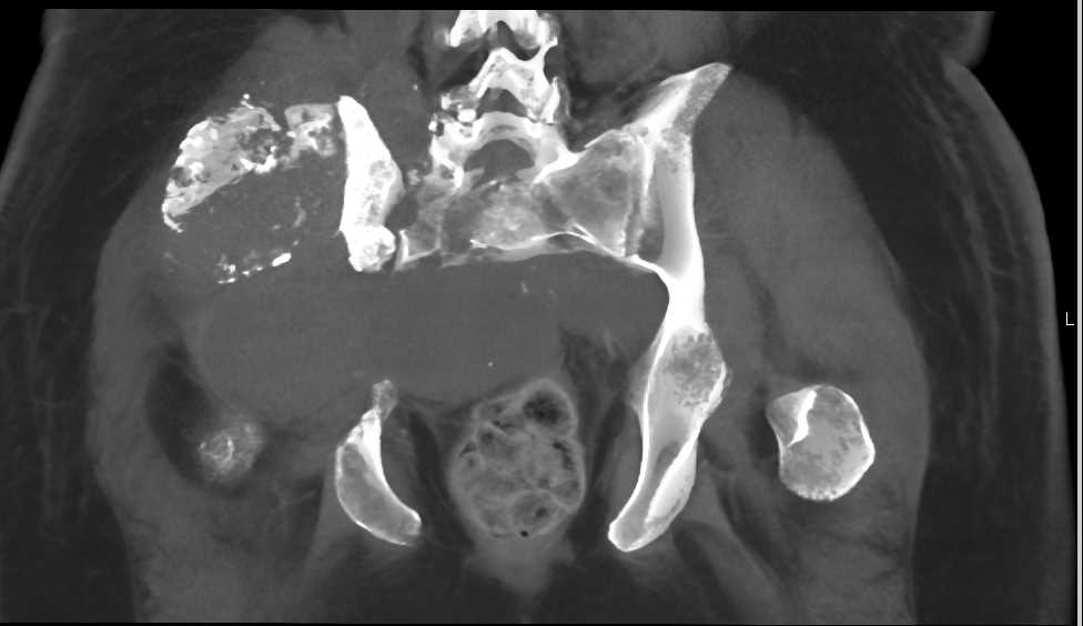 Chondrosarcoma Right Iliac Wing - CTisus CT Scan