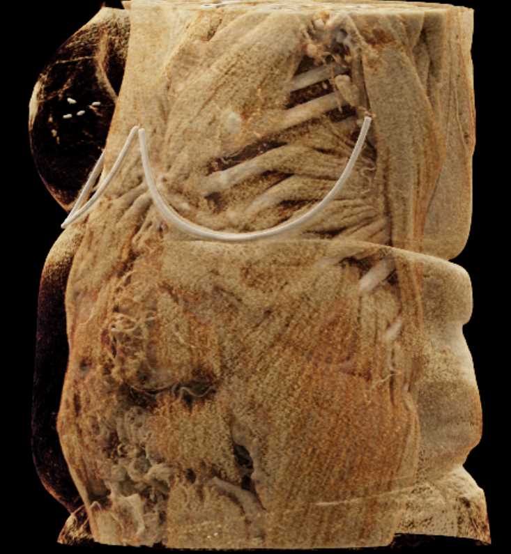 Abdominal Wall Musculature and Vessels - CTisus CT Scan