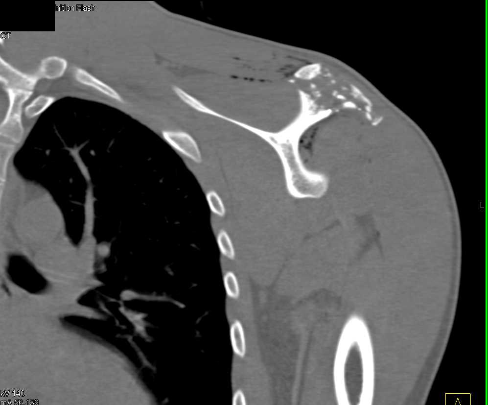 GSW to Shoulder with Scapular Fracture - CTisus CT Scan