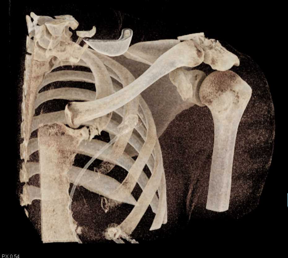 GSW to Shoulder with Scapular Fracture - CTisus CT Scan