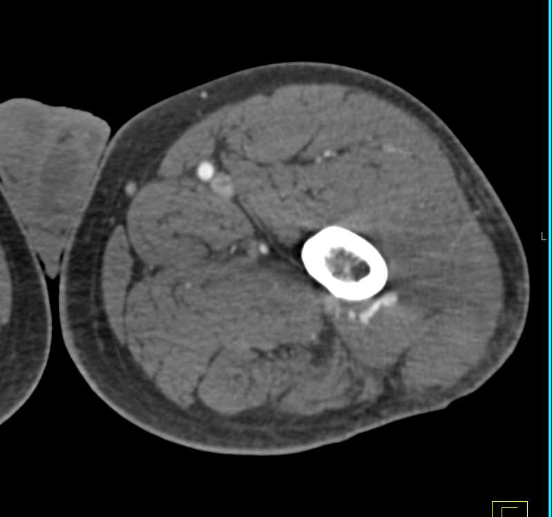 Vascular Mapping Thigh with Early Venous Contamination - CTisus CT Scan