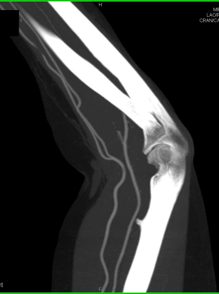 Exostosis Humerus - CTisus CT Scan