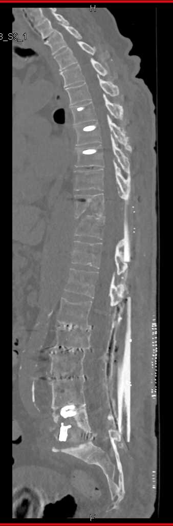 Marked Osteopenia Spine - CTisus CT Scan