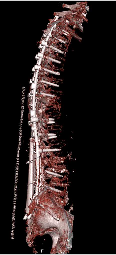 Marked Osteopenia Spine with Hardware in Place - CTisus CT Scan